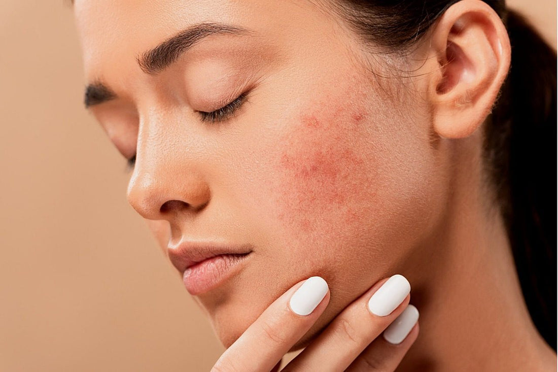 Acne Scars 101: Types, Treatment, and More