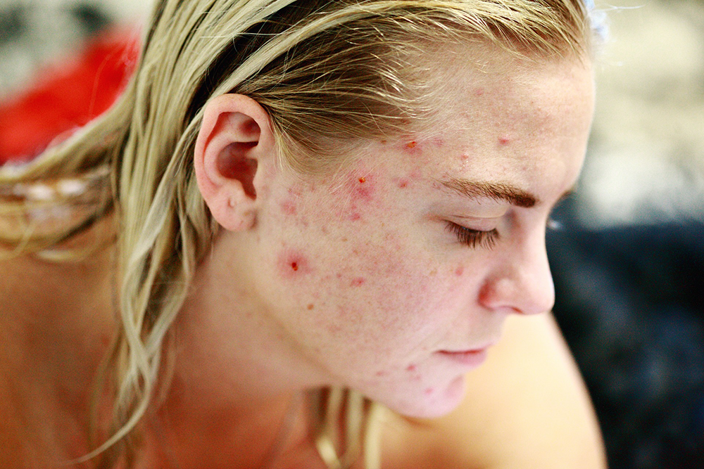 Acne 101: The Six Different Types of Acne and How to Treat Them